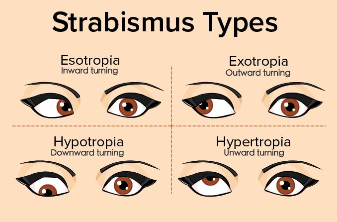 Types of strabismus